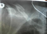 Broken collar bone
